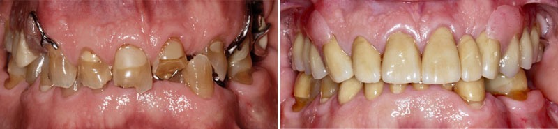 Tooth Wear Before & After